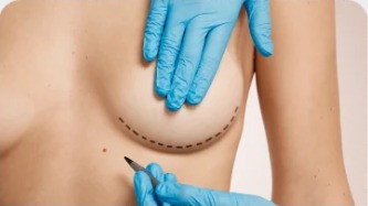 CIRURGIA DE MAMA